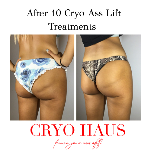 Cryo Ass :: Eliminate Cellulite for Booty Perfection